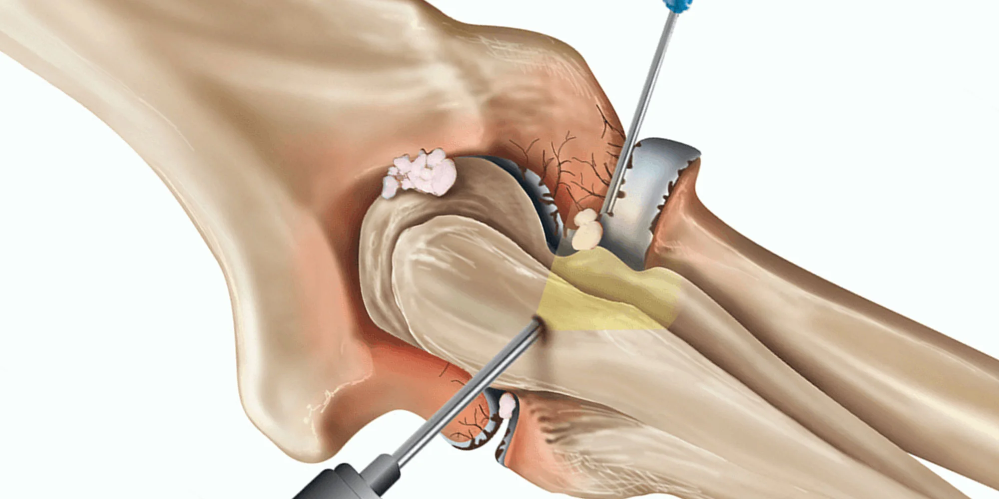 Elbow Surgery and Treatments